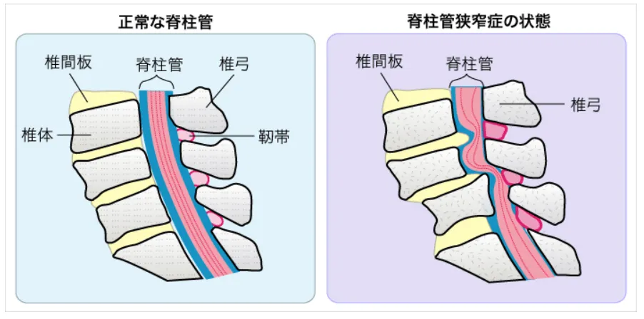 白楽駅周辺で整体による腰部脊柱管狭窄症の痛みとしびれを軽減するコツ