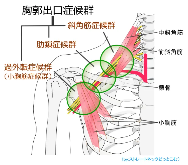肩こりや首こりに悩む方必見!胸郭出口症候群を整体でケアする方法